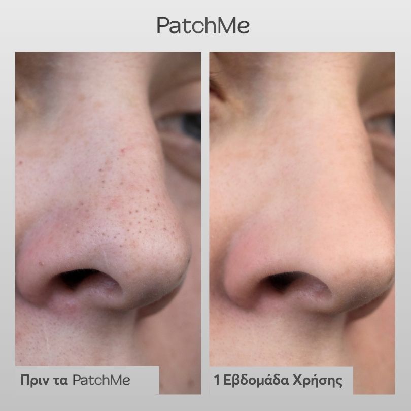 NOSE PATCHES