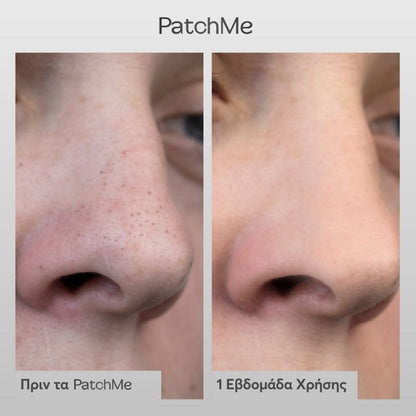 NOSE PATCHES
